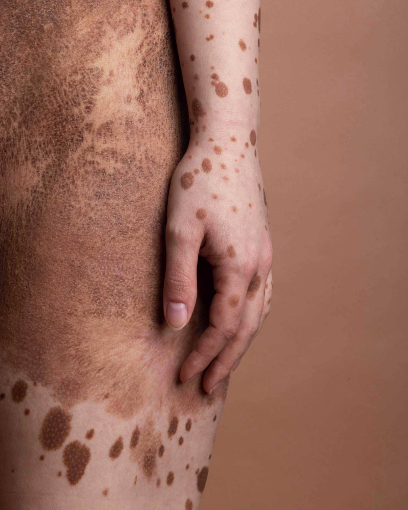 Expressive portrait exploring skin texture, identity, and natural pigmentation patterns.
Intimate body detail highlighting unique pigmentation and organic surface textures.
Natural light portrait celebrating individuality through visible skin markings and soft tones.
Minimal rear portrait with sculptural hair styling and distinctive skin patterns.