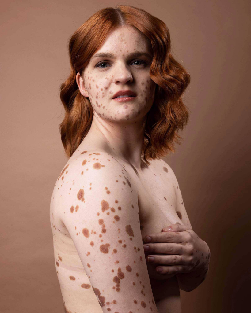 Expressive portrait exploring skin texture, identity, and natural pigmentation patterns.
Intimate body detail highlighting unique pigmentation and organic surface textures.
Natural light portrait celebrating individuality through visible skin markings and soft tones.
Minimal rear portrait with sculptural hair styling and distinctive skin patterns.