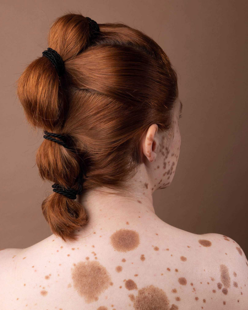 Expressive portrait exploring skin texture, identity, and natural pigmentation patterns.
Intimate body detail highlighting unique pigmentation and organic surface textures.
Natural light portrait celebrating individuality through visible skin markings and soft tones.
Minimal rear portrait with sculptural hair styling and distinctive skin patterns.